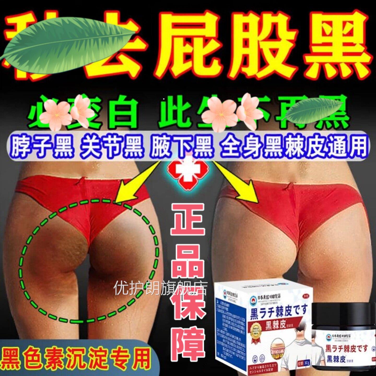 日本脖子大色腿内侧黑素沉淀去除屁股祛坐印臀部发黑坐茧黑棘皮膏