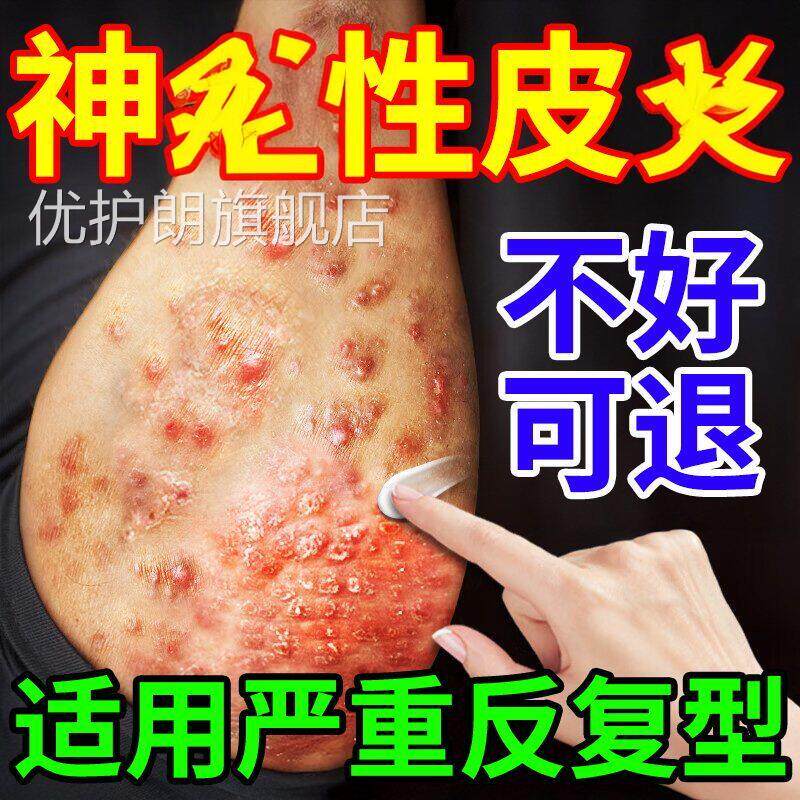 皮肤痒日本进口疗神经性皮顽固反复湿鲜瘙外用膏药病皮疹克星治优