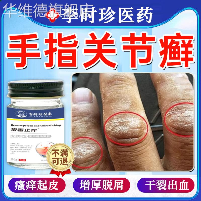 手指关节癣手癣膏脱皮干 干裂真菌感染毒癣康湿疹疱疹止痒药膏正