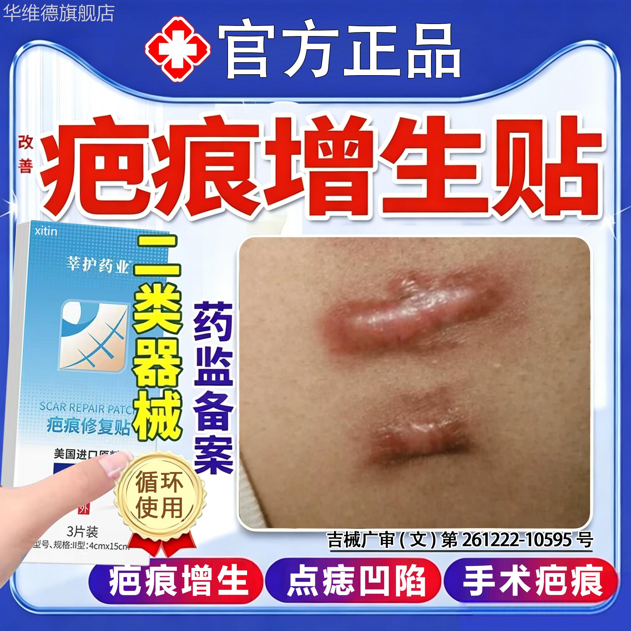 疤痕增生凸起去除疙瘩压力贴防止增生凸起硬肉减张贴剖宫产疤痕FY
