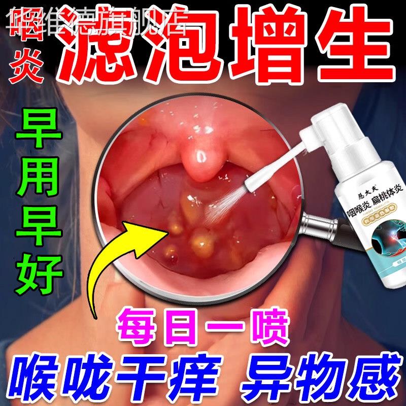 治疗喉咙滤泡增生后壁淋巴慢性咽炎咽喉炎慢性咽炎除根专用喷剂LL