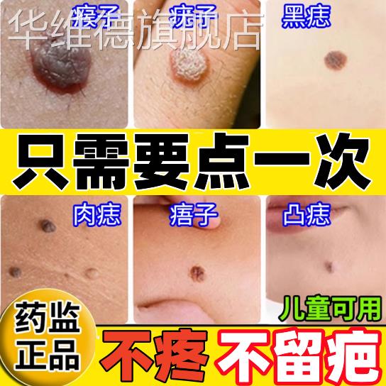 点痣不留疤痕修复液专用点痣膏 任何肤质适用无痕配方正品点痣产