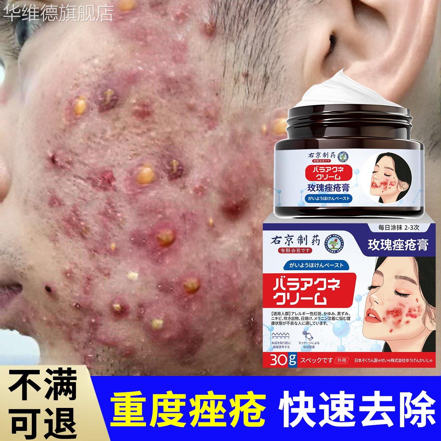 痤疮膏祛痘重度暗疮去青春痘粉刺闭口痤疮祛痘玫瑰痤疮屁股痤疮膏