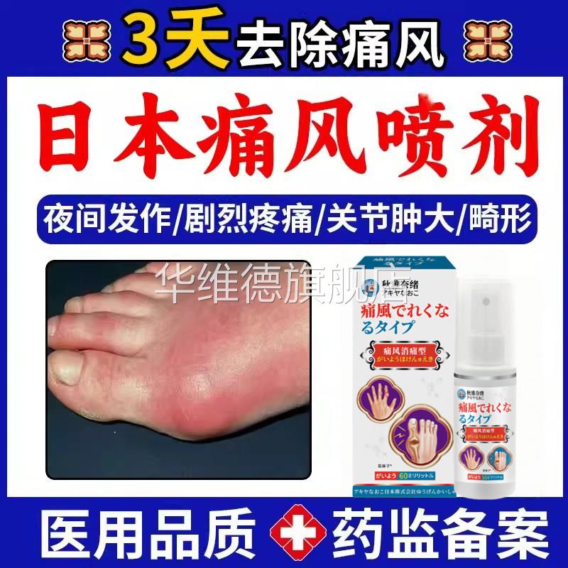 男性痛风关节炎夜间剧烈疼痛溶关节石肿胀畸形冷敷尿酸痛风喷雾剂