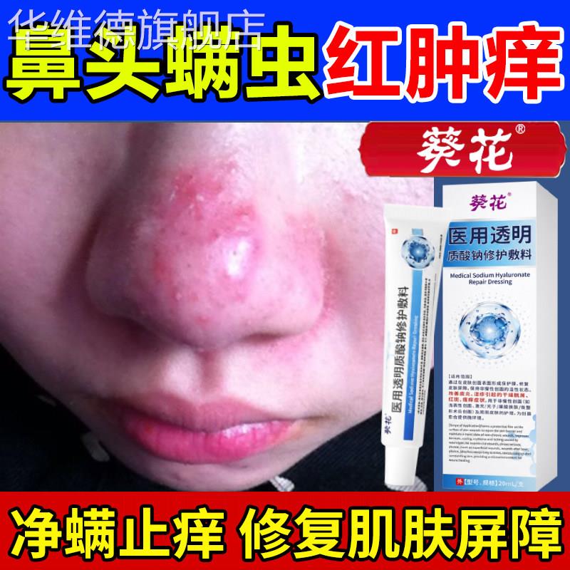 葵花鼻子去螨虫脸上毛囊炎祛痘面部除螨脱皮药膏清洁酒糟鼻头华维