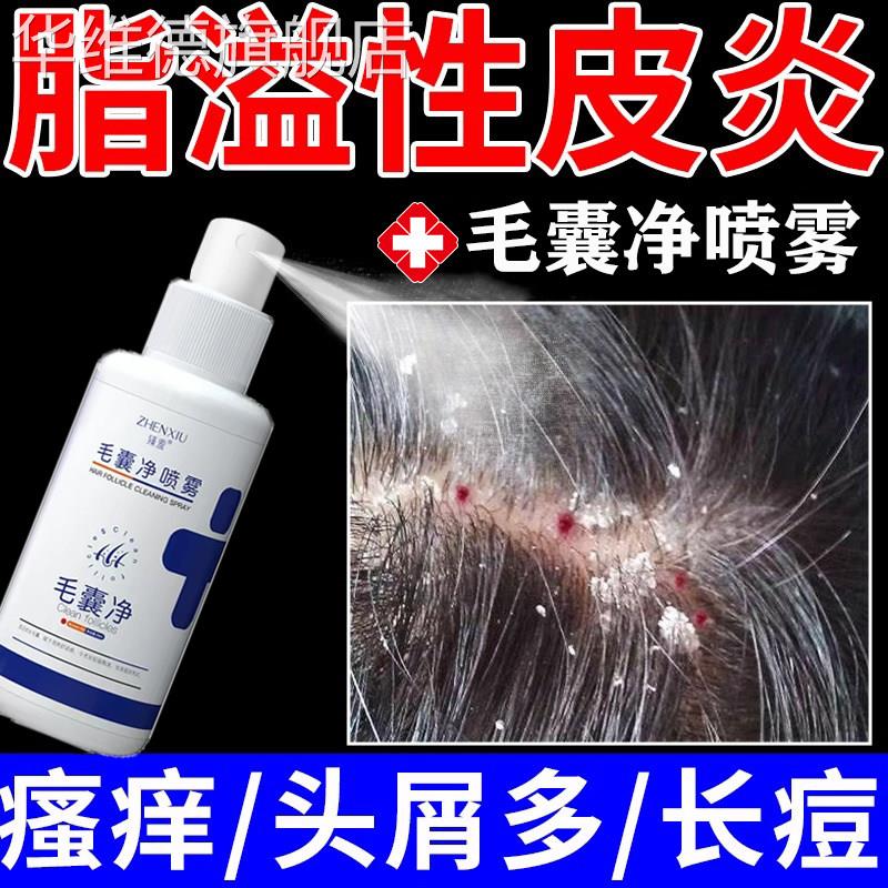脂溢性皮炎头部喷剂止痒头屑头痒专用真菌感染头皮癣毛囊炎喷雾LL