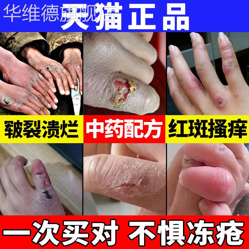 防冻疮膏皲裂止痒冻伤耳朵脸部消肿手足脚干裂冻霜正品修覆冻疮膏
