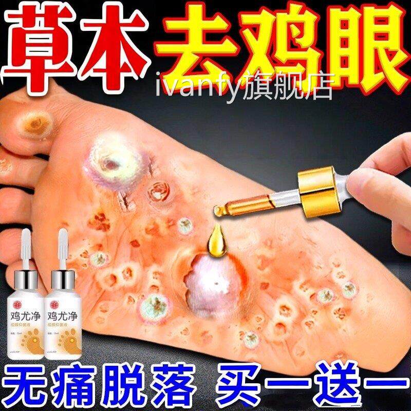 鸡尤净鸡眼药水肉刺扁无平疣去除药膏痛去鸡眼老茧贴跖疣根用专膏