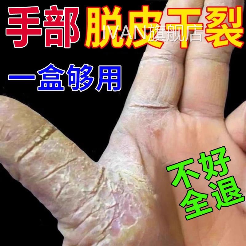 毒癣康膏脱皮干裂真菌感手足癣专药监备案去湿疹止痒根皮染肤病th