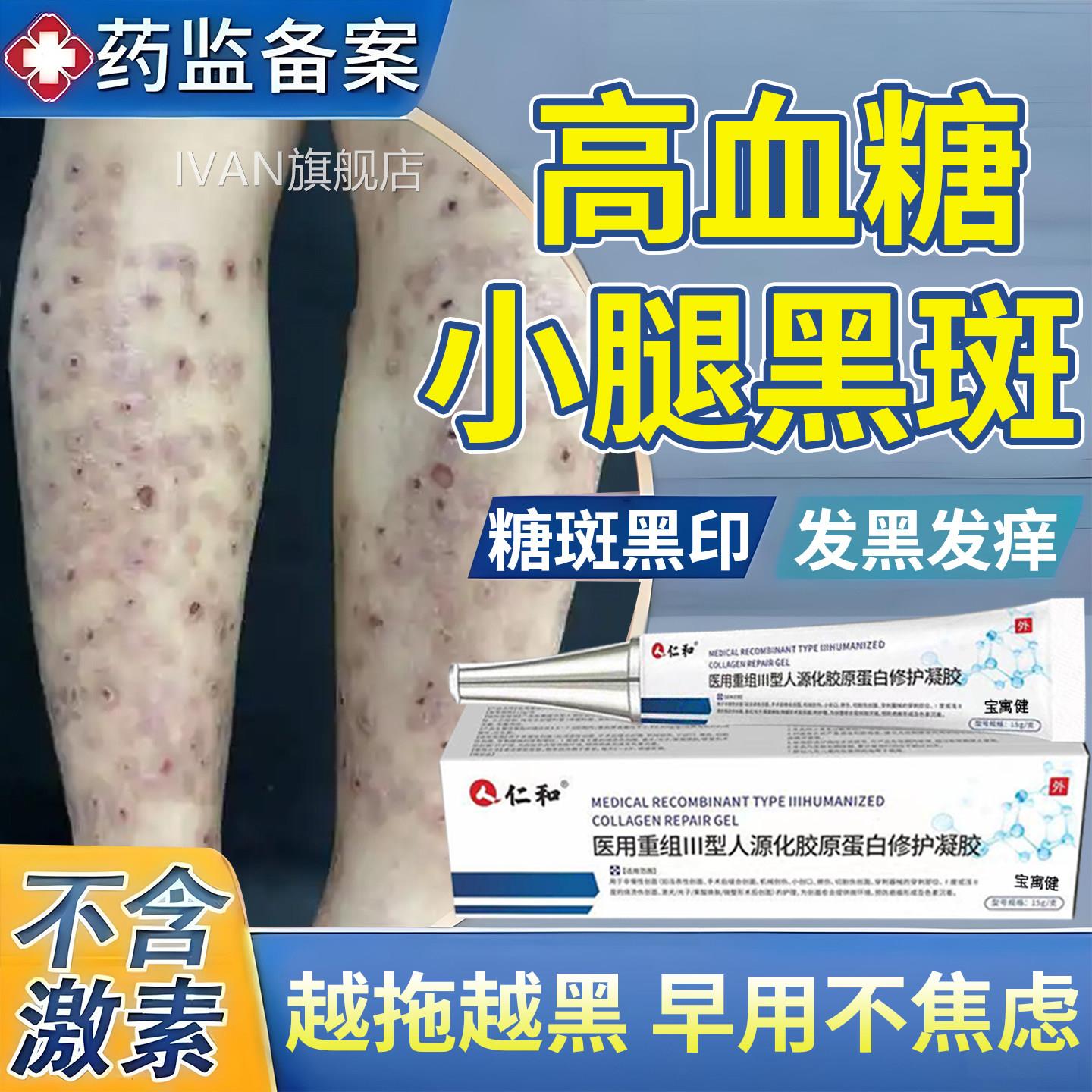 糖尿病疤印引起小腿黑斑去胫前除腿上糖痕斑皮肤痒色素沉着烂足膏