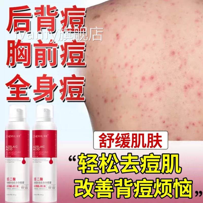 去除前胸背后长痘后背毛囊炎硫磺沐浴露马拉色菌上除痘螨祛痘痒iv