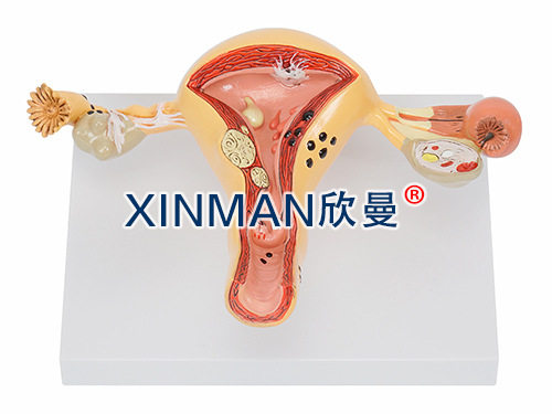 子宫卵巢病变模型