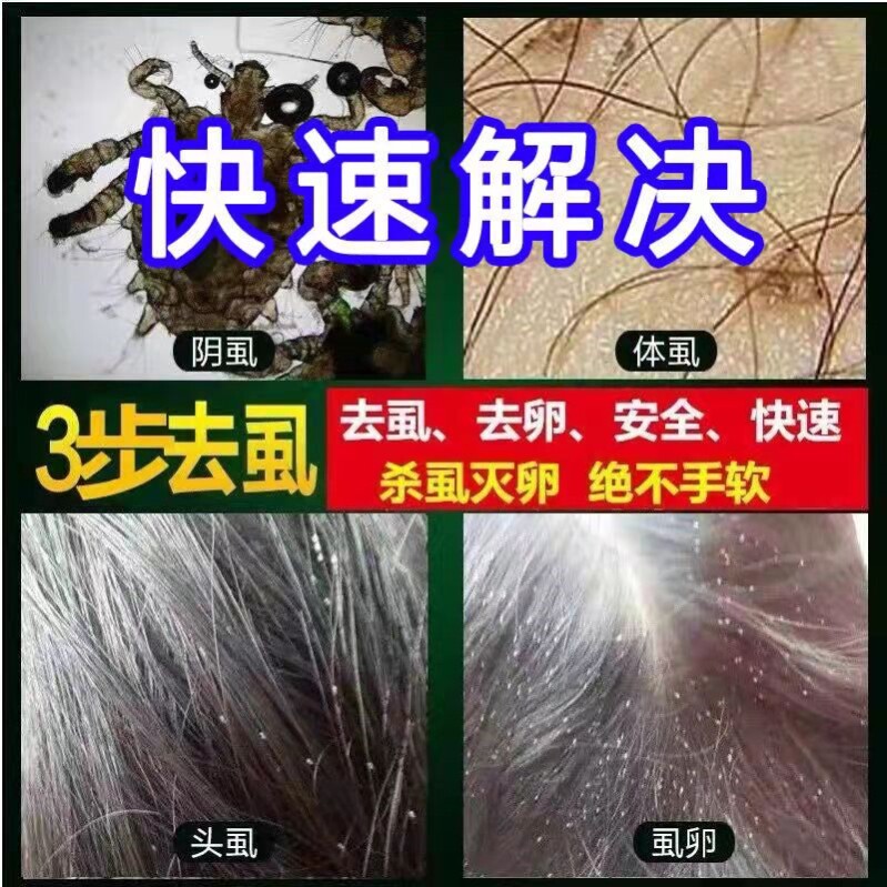虱子药儿童头虱子虱立净灭阴虱头上长的虱卵百部酊去除小女孩头发