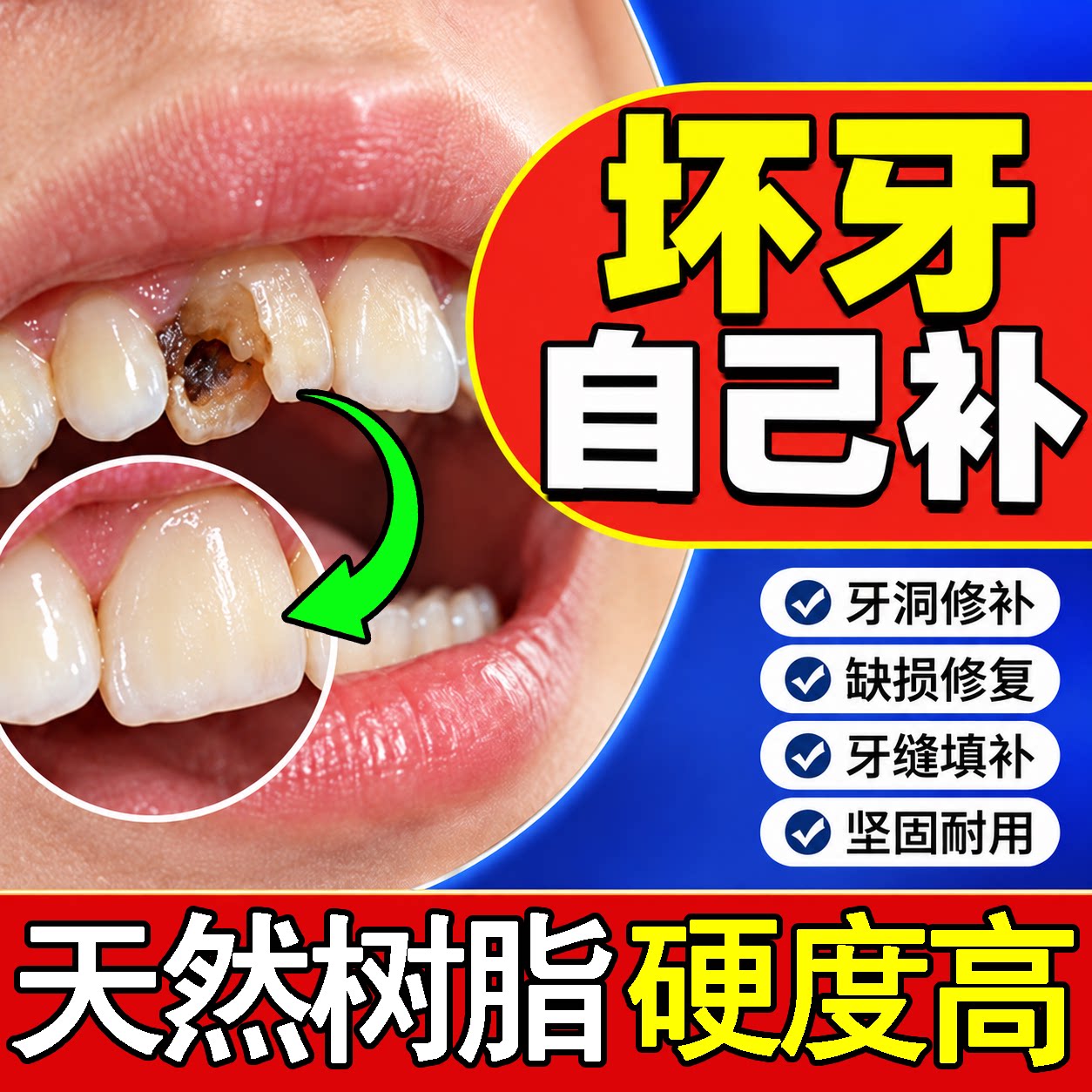 补牙材料自己填充永久医用在家填