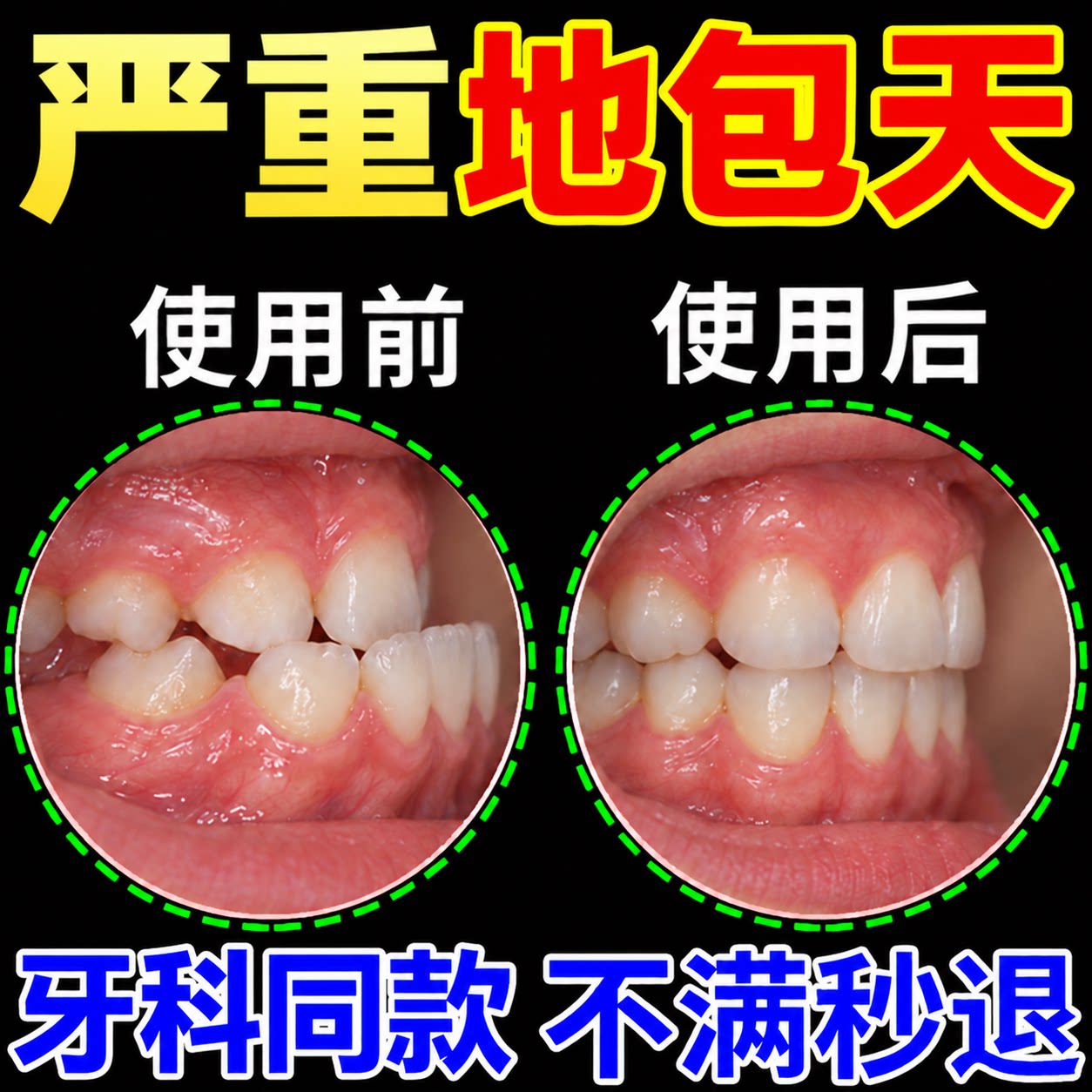 儿童地包天牙齿矫正器