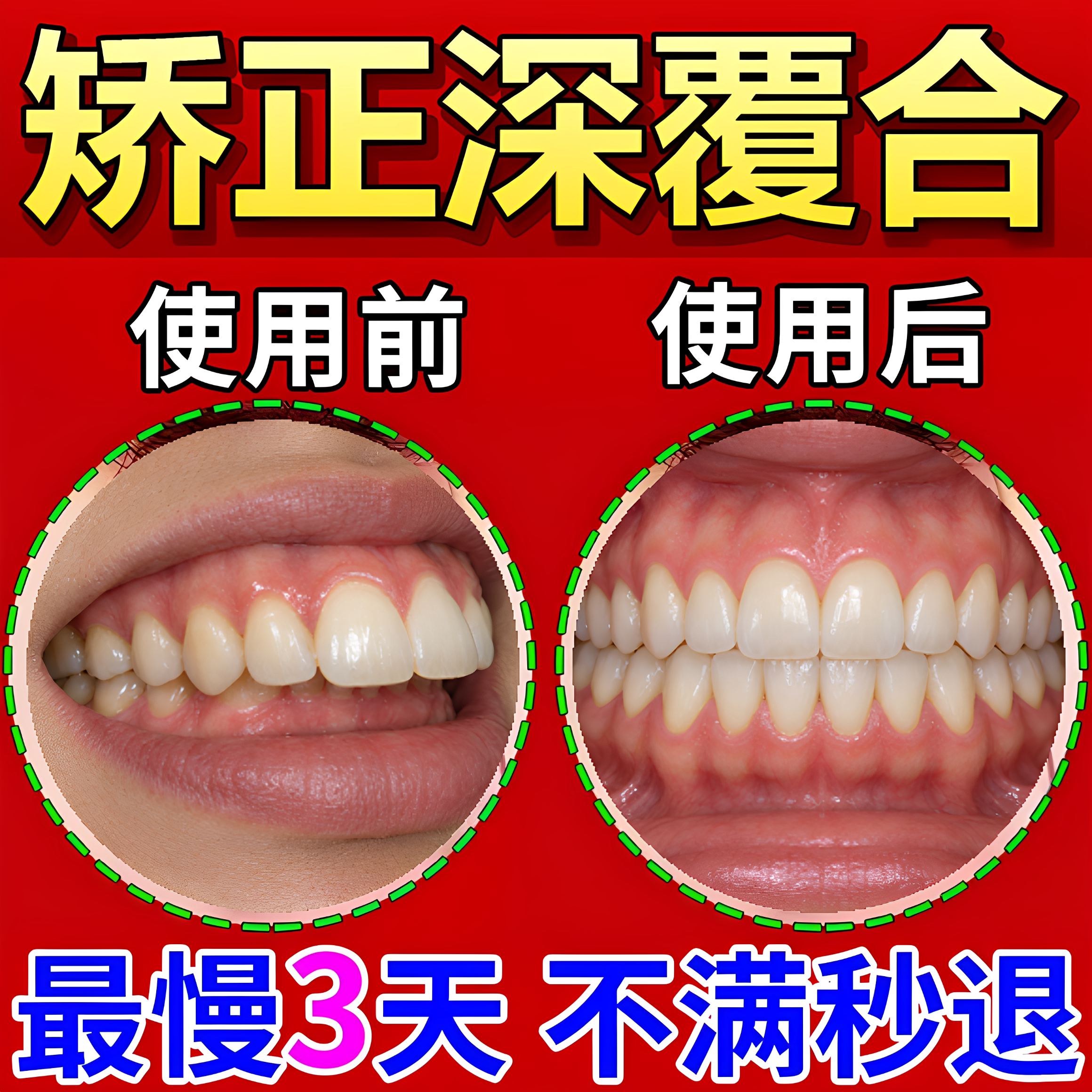 深覆合矫正器睡觉天包地牵引器