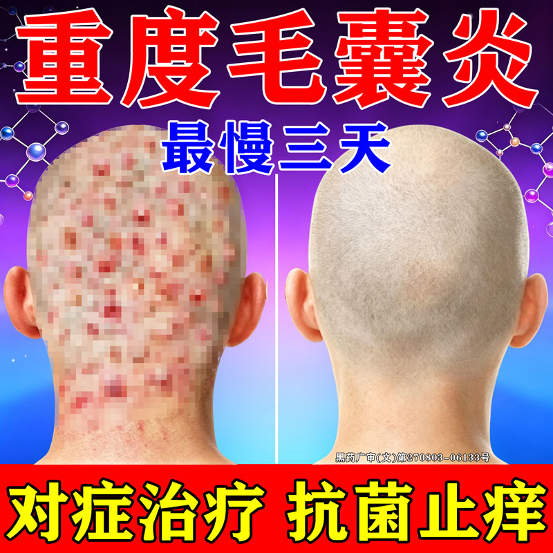 克林霉素甲硝唑搽剂毛囊炎特专用效药头部小疙瘩头皮瘙痒脓包红肿