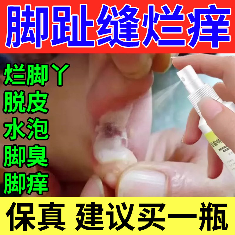 治脚气止痒脱皮杀菌烂脚丫真菌感染专用脱皮糜烂盐酸特比萘芬喷雾