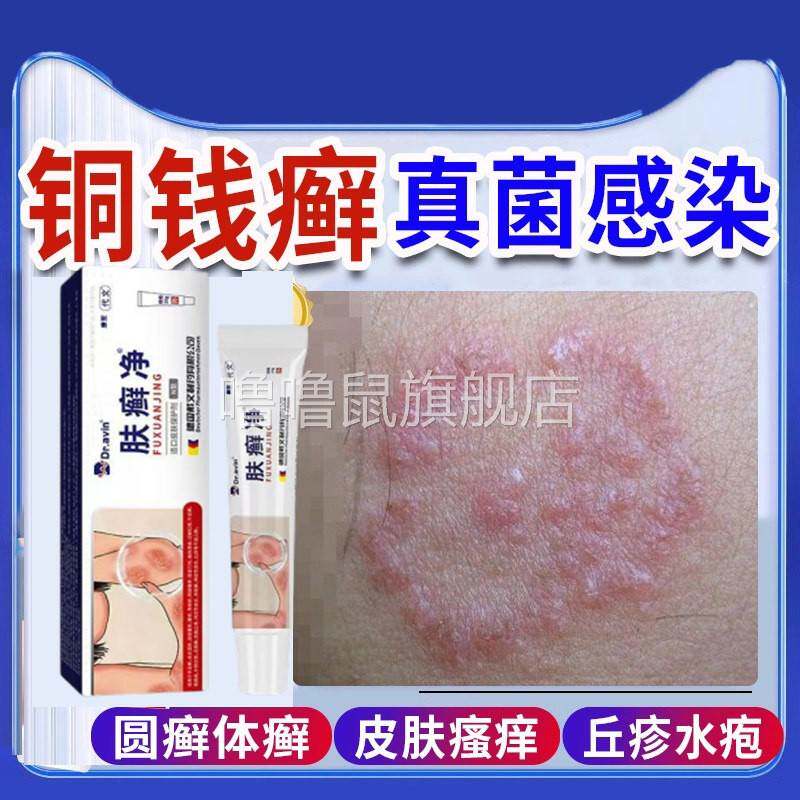 噜噜鼠正品铜钱癣体癣专用去癣皮肤病真菌感染皮肤瘙外用止搭膏药