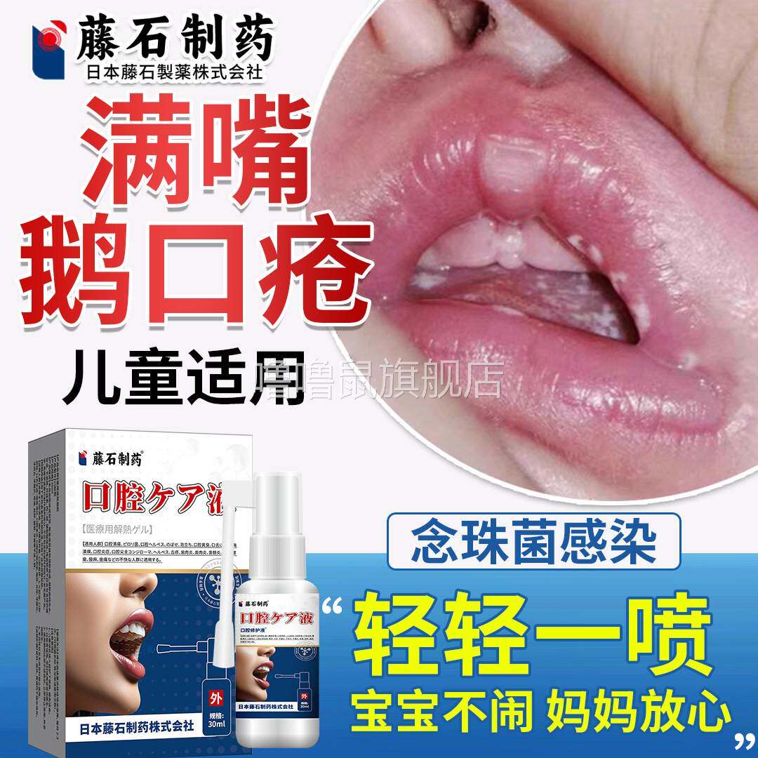 噜噜鼠正品鹅口疮儿童专用可搭药膏的喷剂碳酸氢钠非婴儿德国凝胶