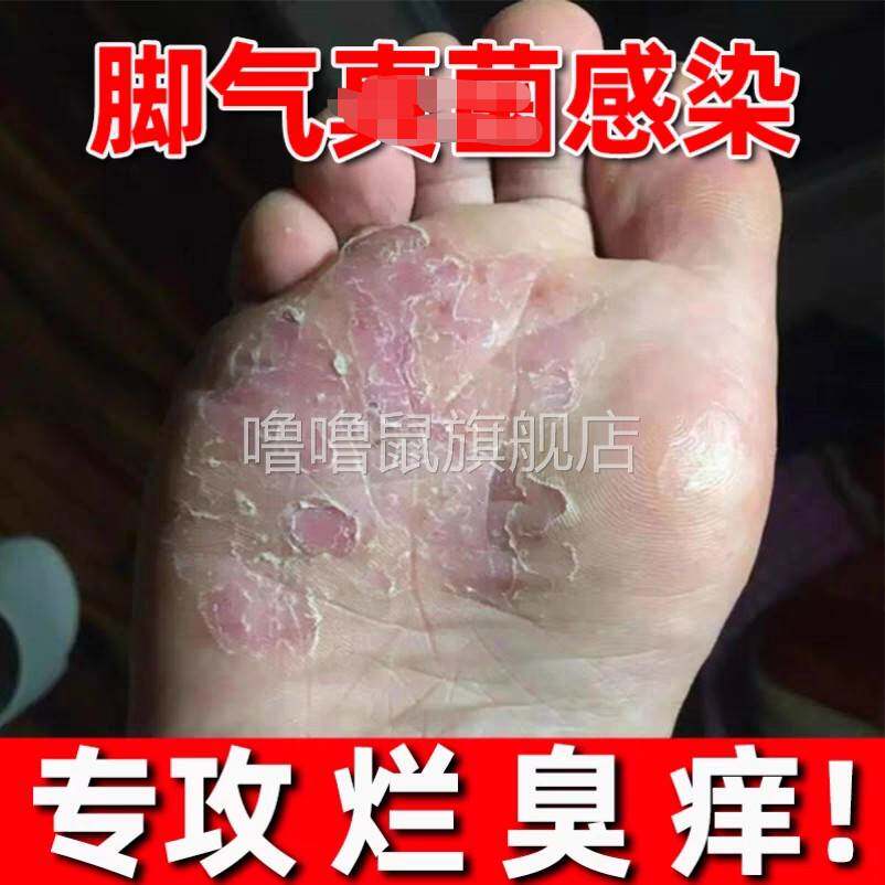噜噜鼠正品修脚店同款创新足选菌之星足爽快速去脚气止杀菌去死皮