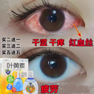 去红血丝滴眼液修复眼睛红缓解眼疲劳干涩发痒流泪充血发黄老花眼