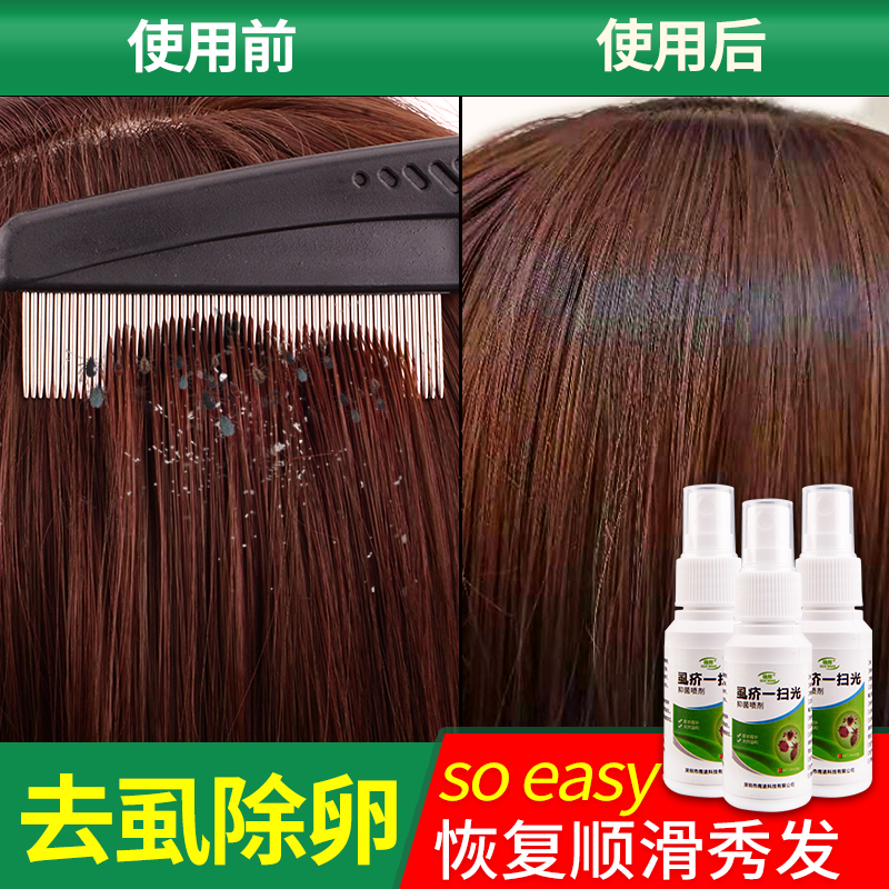 篦子梳虱子梳除头虱女儿童头发去虱蚤箅子蓖子超密加密细齿木梳子