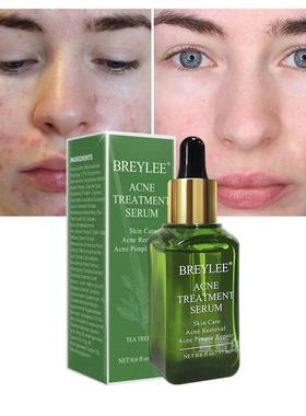BREYLEE 祛痘精华原液17ml抗痘粉刺去青春痘黑头修复肌肤收缩毛孔