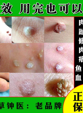 血胞刺去除膏鱼鳞痣贴手足部点治祛候子跖又灵净正品痦子疣瘊灵
