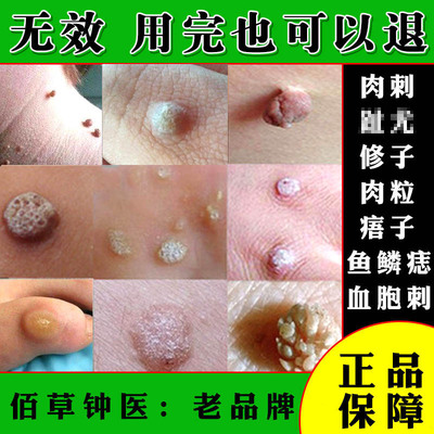 血胞刺去除膏鱼鳞痣贴手足部点治祛候子跖又灵净正品痦子疣瘊灵