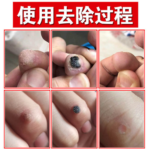 祛肉刺去除正品鱼鳞痣贴手足部膏点治候跖又血胞刺去除膏灵净