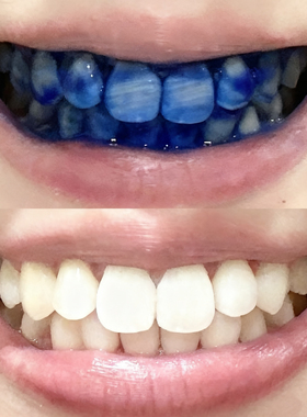 白牙它太有发言权！重度黄牙直接逆袭！！牙膏