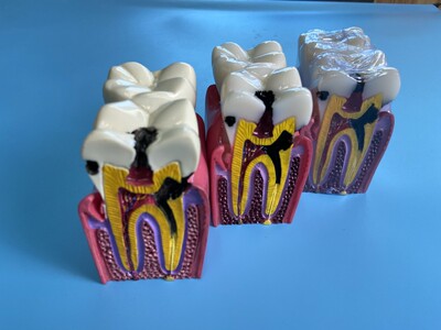 牙科正常对比牙模分解厂家直销