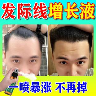 发际线增长液发际线后移高额头生长液女士通用毛发生长液喷剂