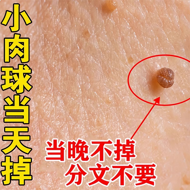 正品草本克尤膏去除脖子丝状忧猴子膏腋下肉粒刺寻常忧皮赘扁平尤-封面