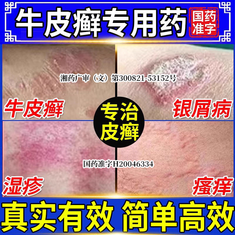 治疗顽固牛皮癣银屑病专用药膏水体癣真菌感染官方旗舰店非特效NN