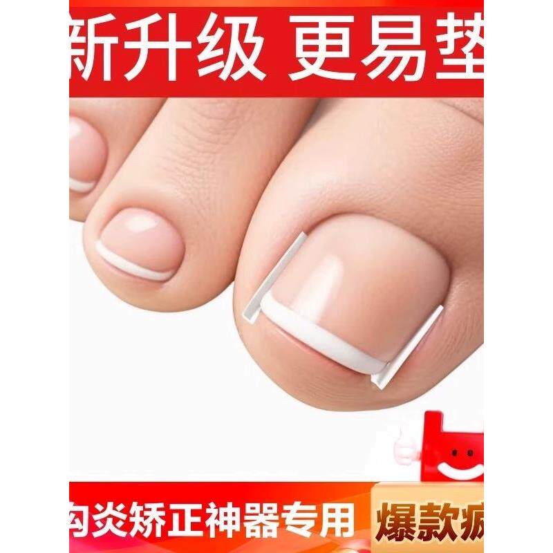 甲沟矫正器填充垫片炎嵌