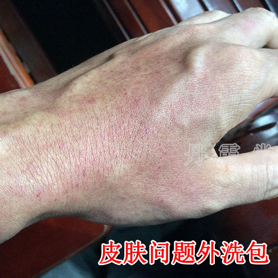 皮肤红斑红肿过敏红疹菲子干燥痒湿毒水泡热痒止痒泡澡中草药材包