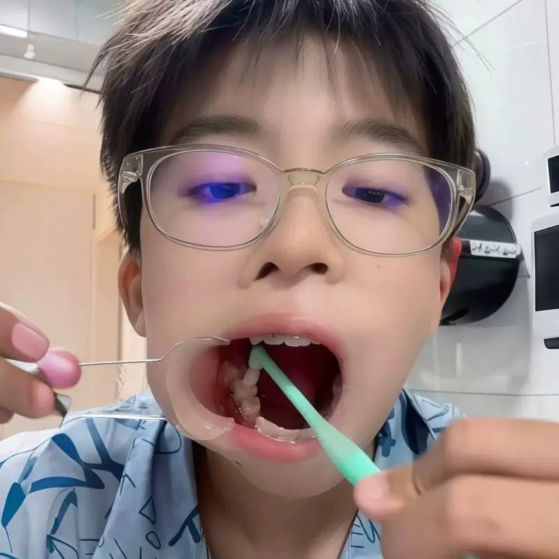 儿童牙缝清洁扩口器正品清理工具