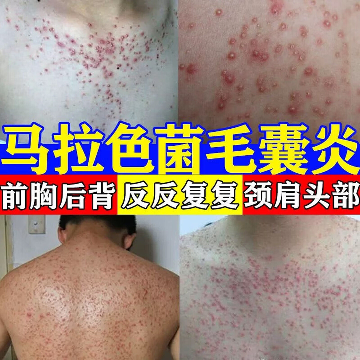 治毛囊炎头皮痒头上长痘痘疙瘩脓包后背马拉色菌专用草本乳膏正品