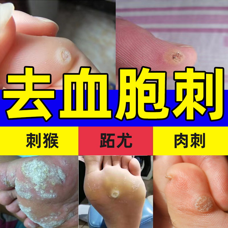 血胞刺血泡刺贴甲周疣儿童刺猴老鼠痣贴鱼鳞痣膏非去除膏神器专用