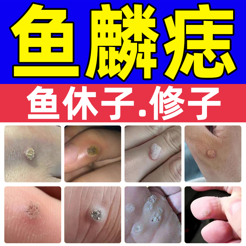 鱼鳞痣血胞刺鱼休子老鼠痣瘊子