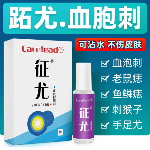 血胞刺老鼠痣鱼鳞痣去除膏