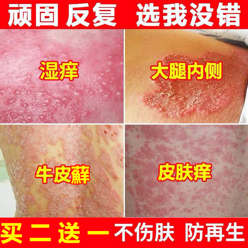大苗王蘚痒清牛皮鲜蘚銀屑外用成人止痒软膏药膏专用老偏方癬股蘚|ruв категории туалетные чище/санитарно - гигиенических салфеток/бумага/Ароматерапия, шампунь/человек чистой, уход за телом, других продуктов по уходу за телом - от Buy2taobao.com для оказания профессиональной услуги покупки агента Taobao