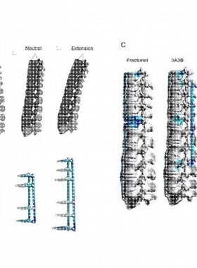 医学有限元分析 生物力学彷真模拟 Ansys Workbench有限元分析.