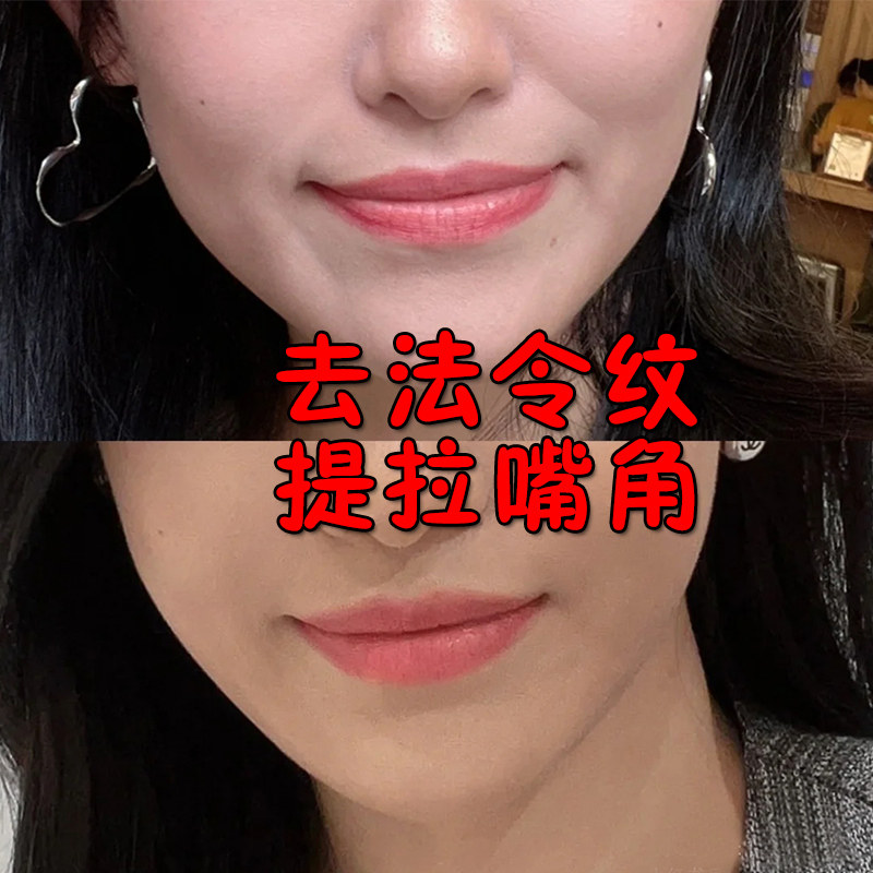 嘴角上扬矫正神器面部肌肉训练微笑法令纹木偶纹消除下垂提拉紧致