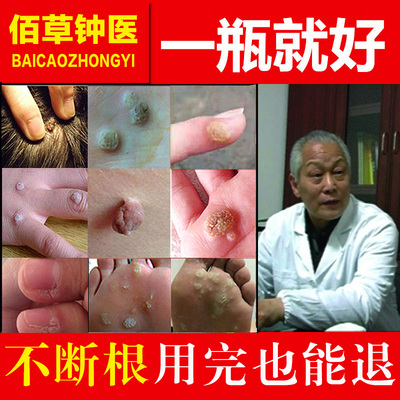 去除肉刺猴子肉粒手足部正品