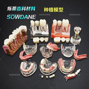 牙科种植牙模4钉上 下 2钉下4倍牙齿 展示 医患沟通口腔教学模型