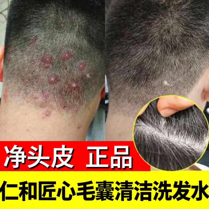 仁和匠心毛囊洗发水除螨头部深层清洁控油止头皮痒洗发露官方正品