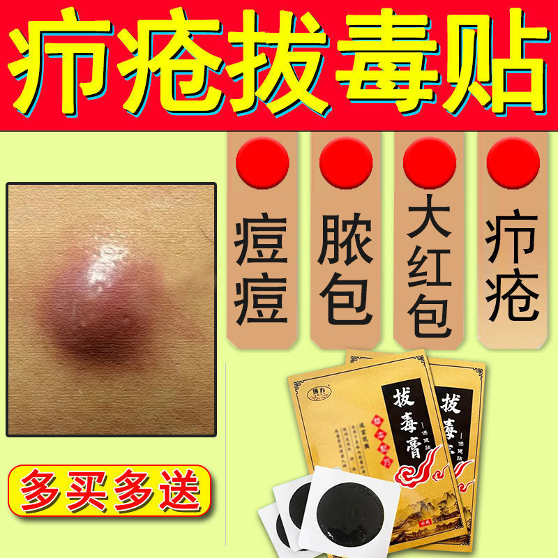拔毒膏火疖子拔脓 脓包型痘痘屁股长硬块痤疮克藓拔毒华佗止痒膏